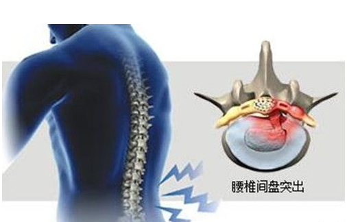 测测你的腰疼属于哪一种？(图3)