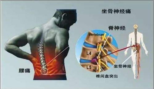 测测你的腰疼属于哪一种？(图4)